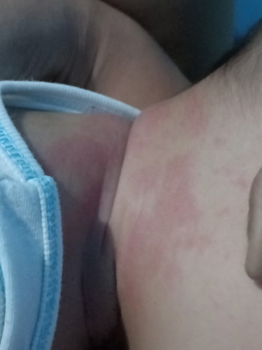 Rash