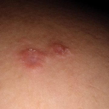 เป็นตุ่ม