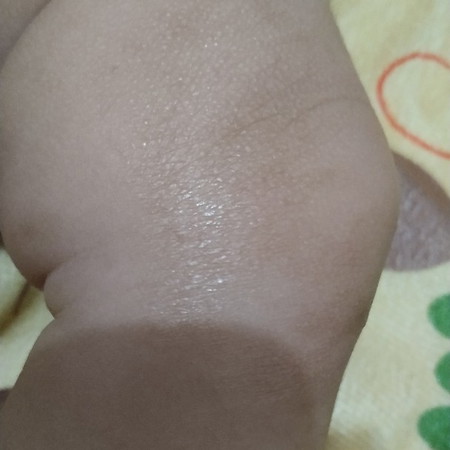 kaki bayi seperti kurap