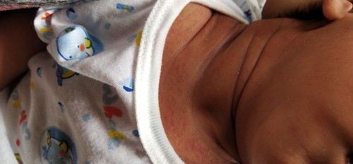 ผดเหงือ