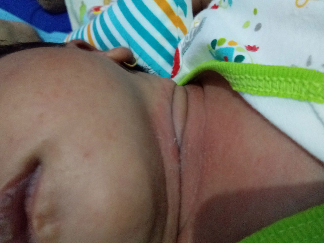 bayi usia 18 hari bintik² merah dileher