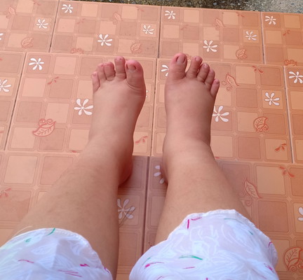 อาการเท้าบวม