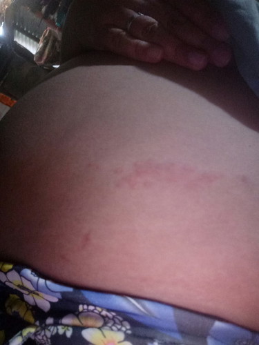 rashes?