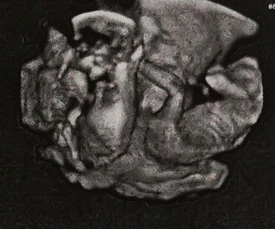 อวดรูปอัลตร้าซาวด์​ ลูกสาว-ลูกชาย