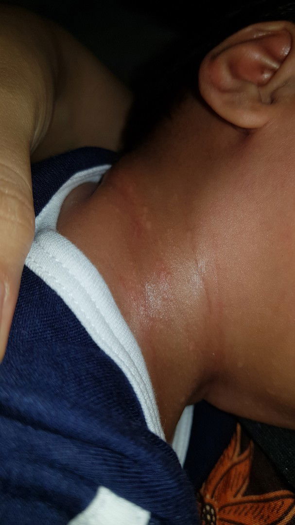 Bentol di lipatan leher bayi