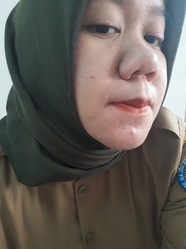 ada yg mukanya kena milia saat hamil?