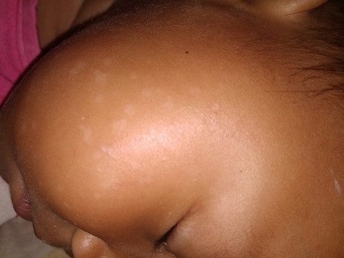 bintik2 putih di pipi