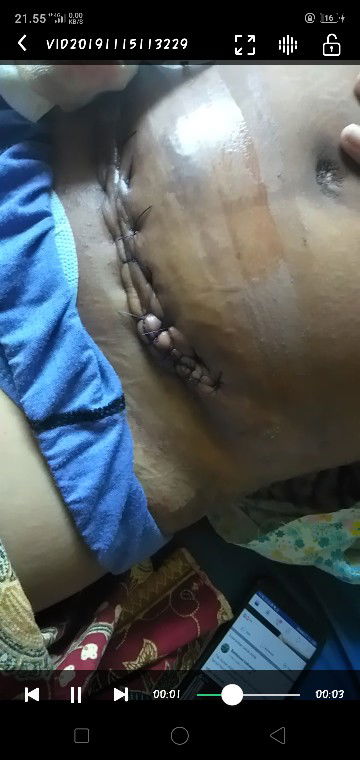 konsul,gagal induksi,op,infeksi,op ulang,jaitan amburadul