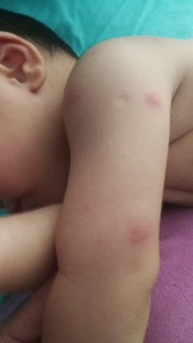 ตุ่มแดงคะ