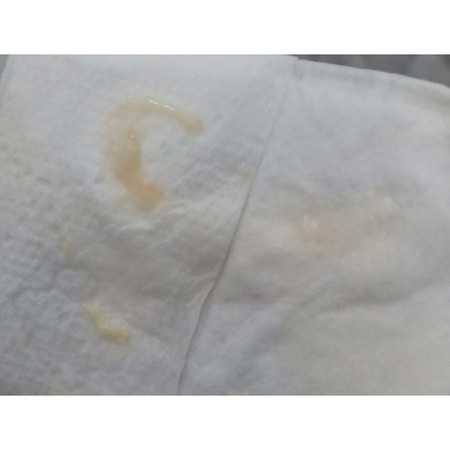 ตกขาวปนเลือด..ยังไม่ถึงรอบประจำเดือนมา