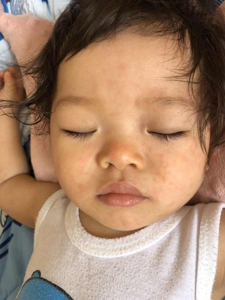 มีไข้ ผื่นขึ้น