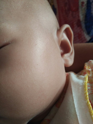 ผิวเด็ก