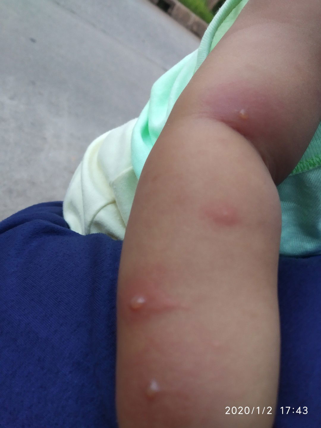 bintik berair/melenting