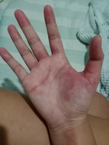 คลอดลูกได้อาทิตย์นึง คันฝ่ามือฝ่าเท้า หลังมือหลังเท้า เป็นอาการแพ้หลังคลอดหรือเปล่าคะ