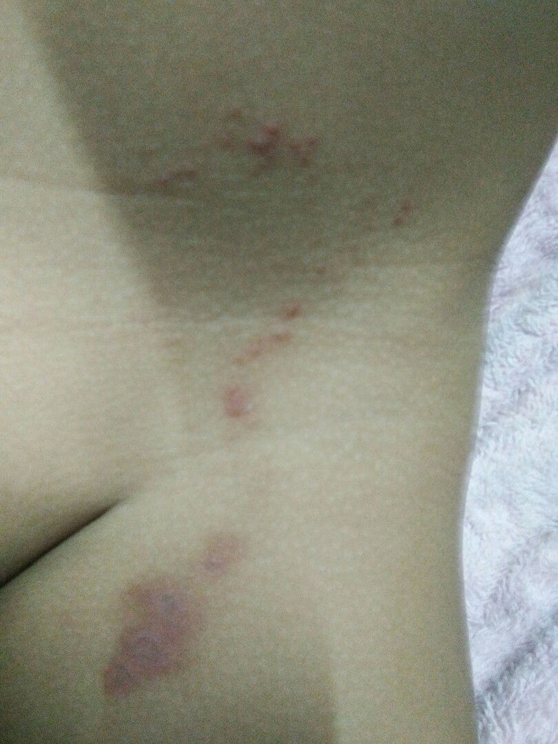 น้อง 1 ขวบ 4เดือน มีผื่นแดงๆคล้ายแผลพุพอง