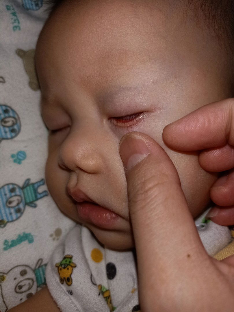 ตุ่มที่ขอบตา