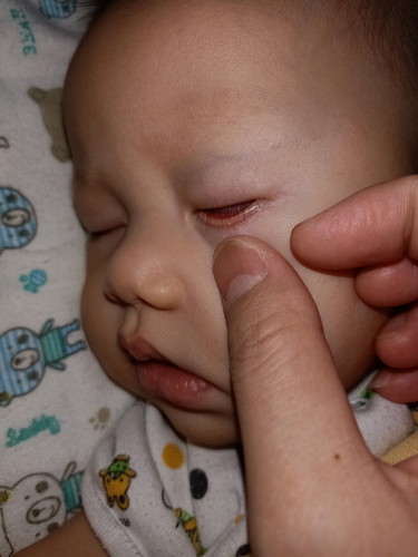 ตุ่มที่ขอบตา