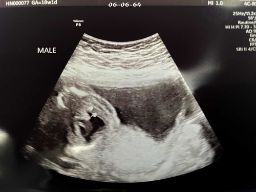 แม่ๆทีม พฤศจิกายน ได้ลูกสาวหรือชาย ขอดูภาพหน่อยคะ☺️