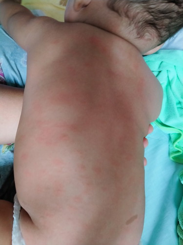 ผื่นร้อนกับผื่นแพ้อาหารต่างกันไหม