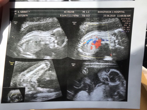 18 w ได้ลูกสาว กำหนดคลอด 24/11/62 ท้องแรก