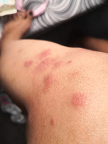 Skin problem