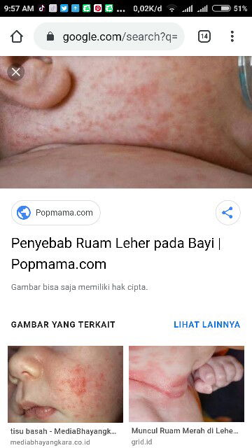 leher bayi berjamur dan Infeksi