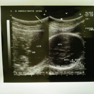 USG di 26 minggu