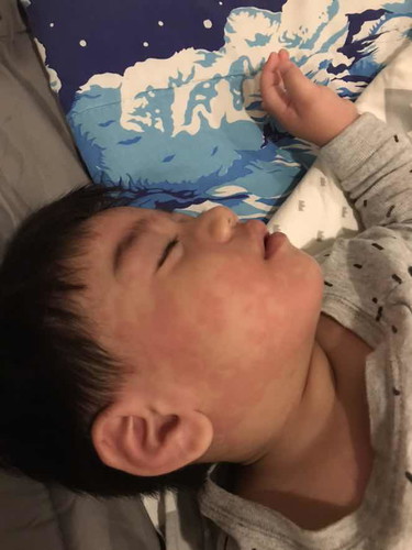 ขึ้นแดงมา2วันแล้วไปหาหมอแล้วแต่ยังแดงอยู่เลย