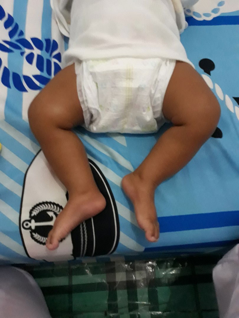 bentuk kaki bayi