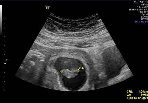 usg 8minggu di tengah