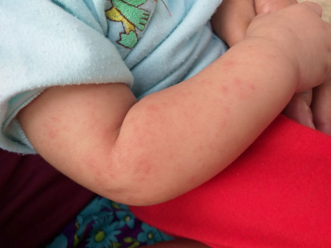 biang keringat atau apa ya?