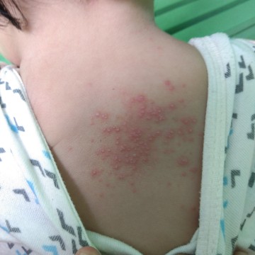ruam merah di punggung bayi