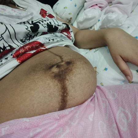 tummy after giving birth