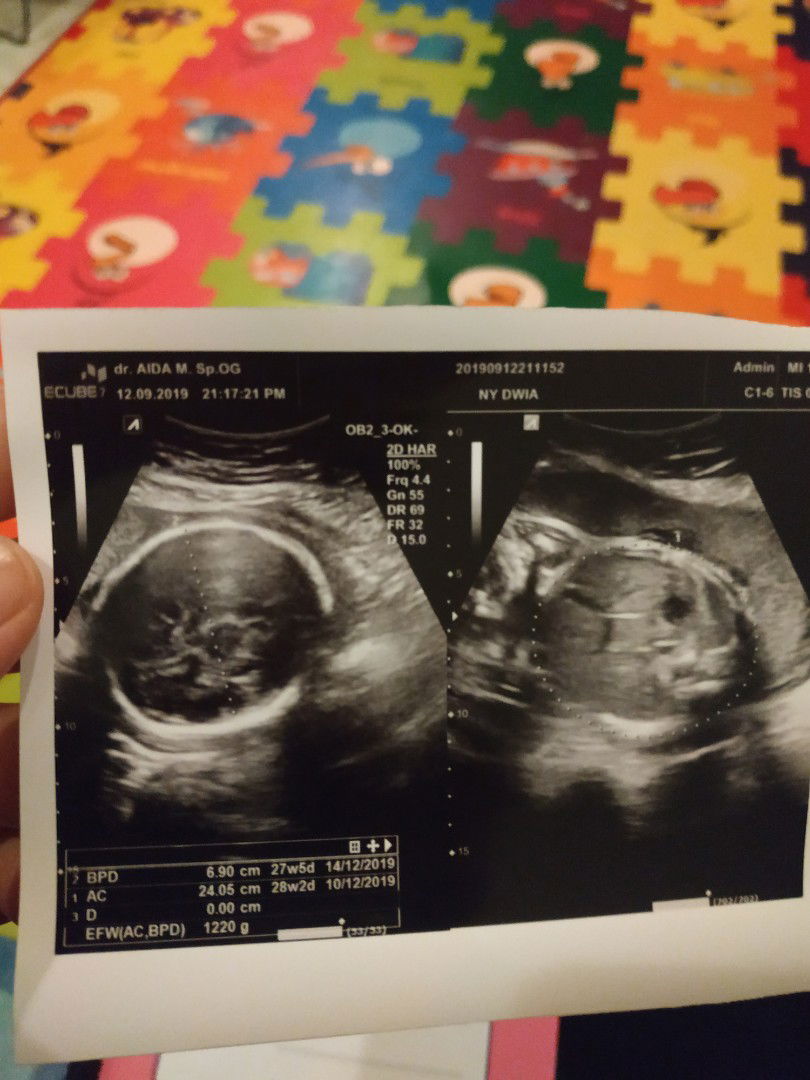 Hasil usg 28w2d