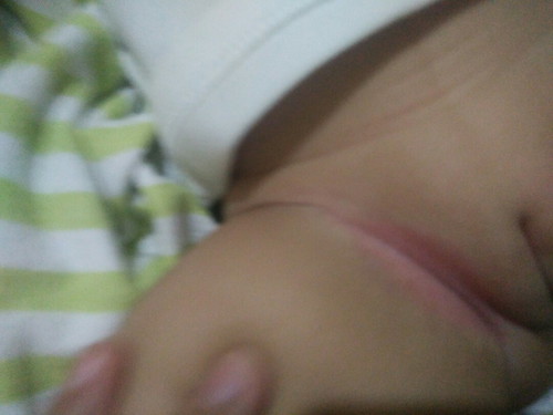 baby rashes