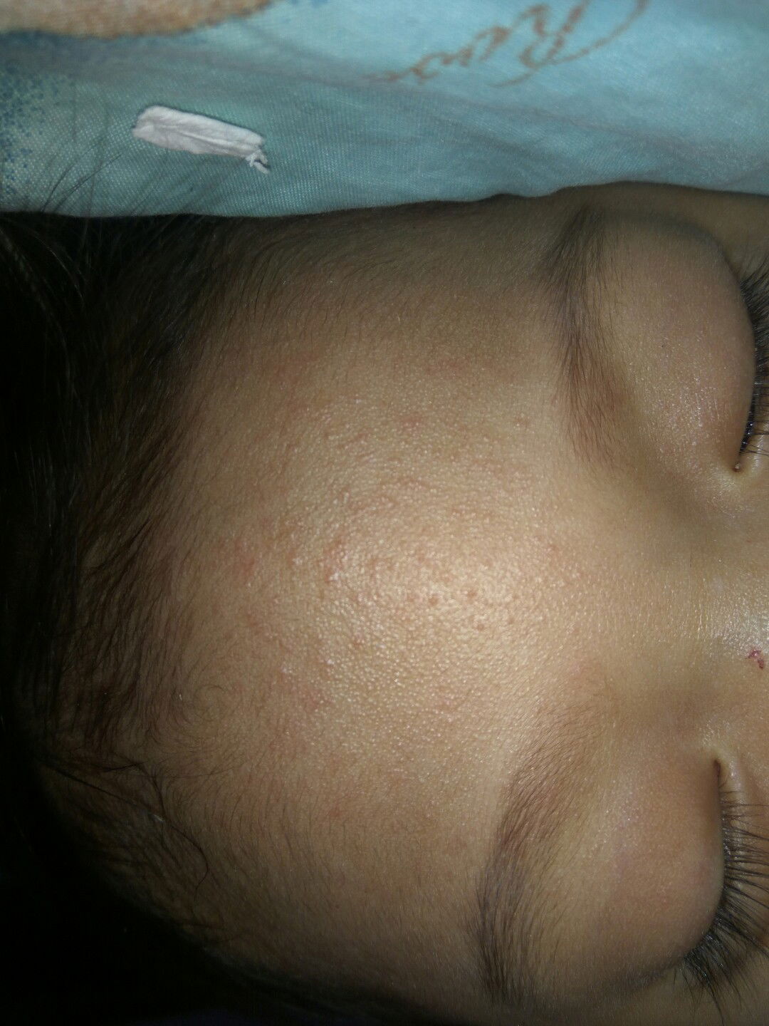 biang keringat atau alergi