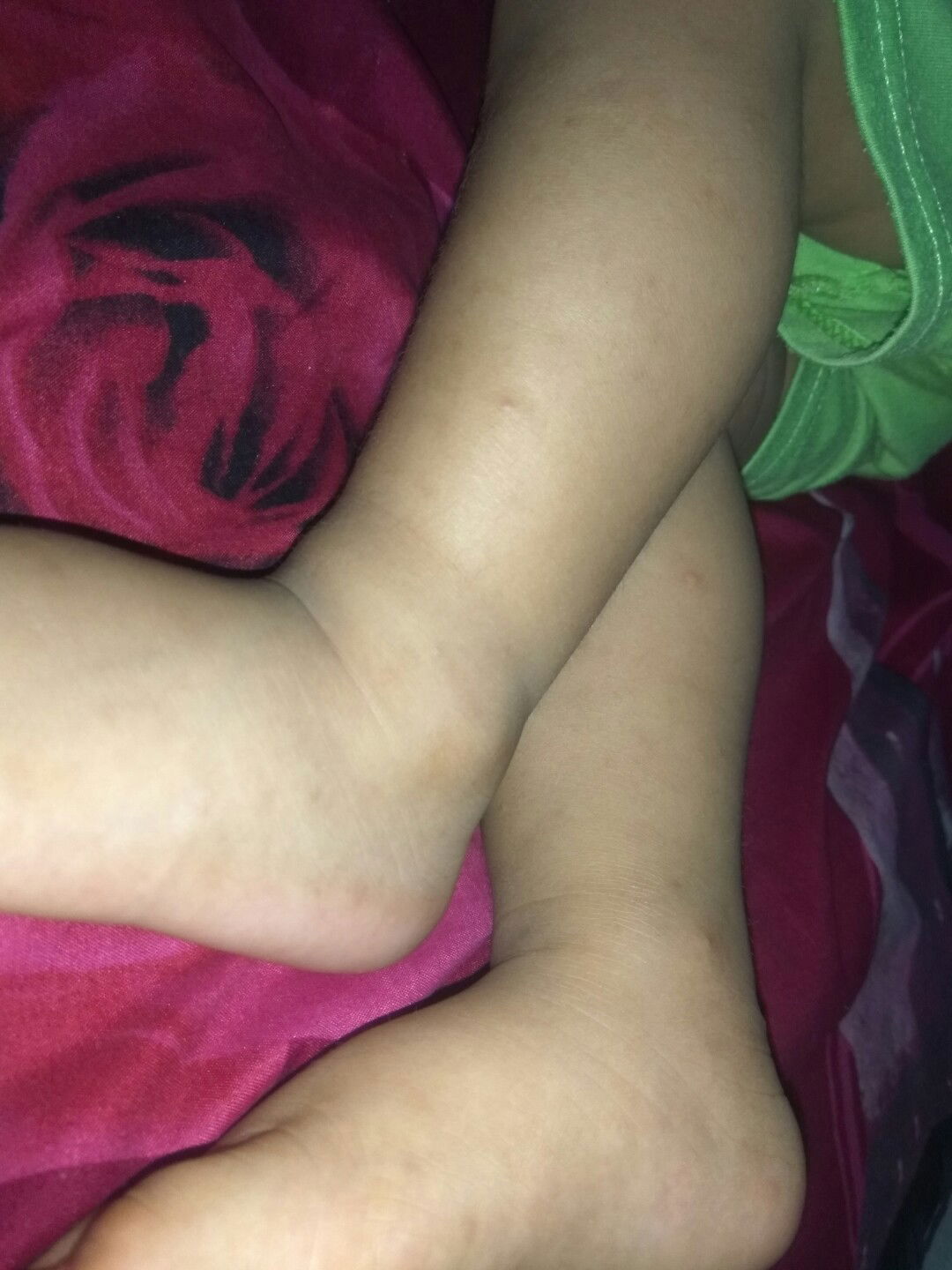 cara menghilangkan bekas gigitan nyamuk