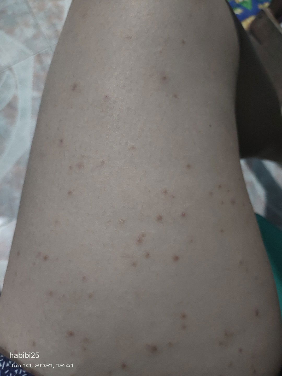 good day mga mommies. ask ko lang sana sino nakaranas ng skin rashes na makati at parang butlig?