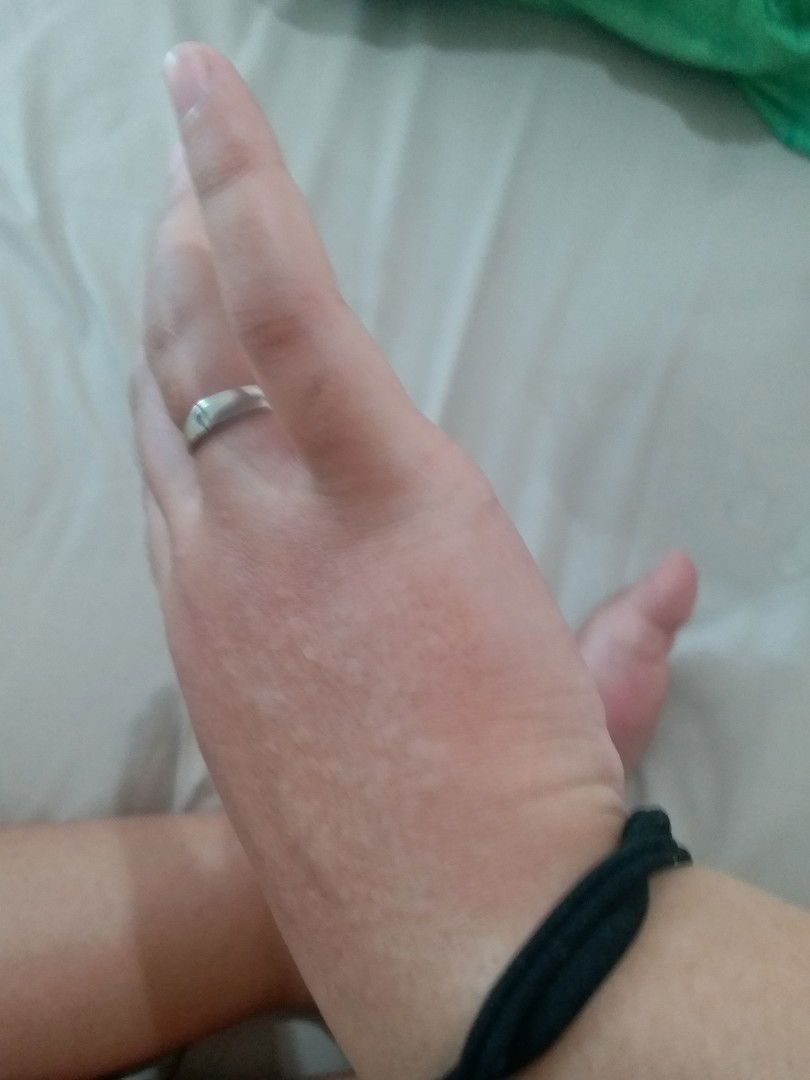 Bercak Merah dan Bentol-Bentol