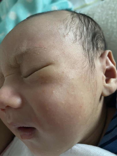 ผื่นแพ้รึเปล่า