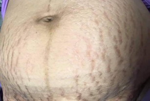 ลายแตกสีแดงกับสีขาว