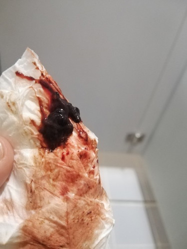 ท้อง8สัปดาห์มีก้อนเลือดออกมา