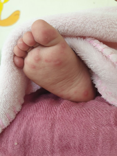 Hand Foot and Mouth Disease