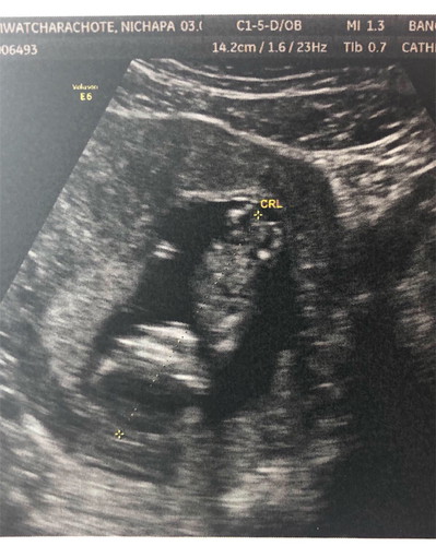 อุลตร้าซาวด์ตอน12week 4วัน