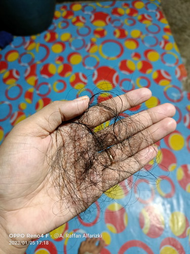 Rambut rontok