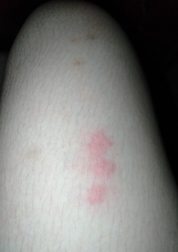 เราเป็นผื่นแบบนี้ตั้งแต่ก่อนตั้งครรภ์เลยค่ะแม่ๆ รักษายังไงดี 😭