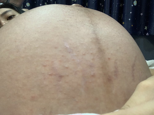 ท้องแตก