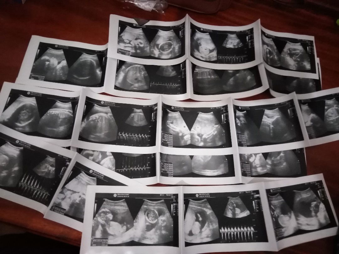 ป้าหมอนัด​ 38+4