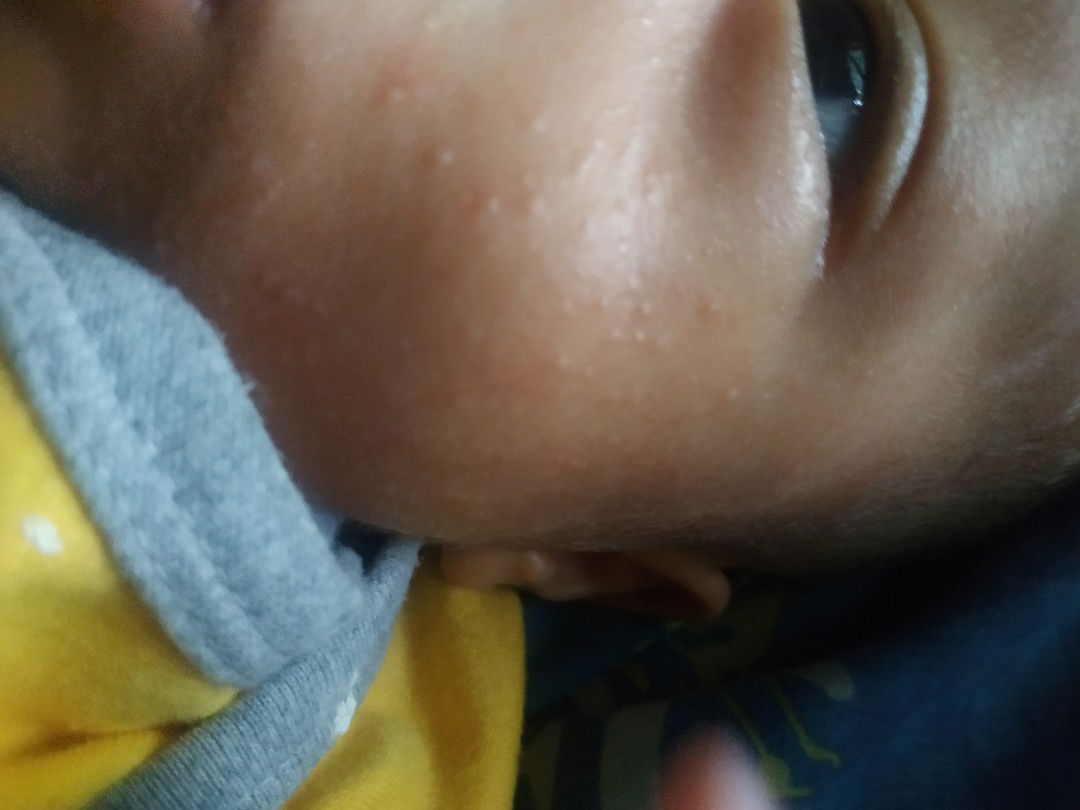 Banyak beruntusan di wajah