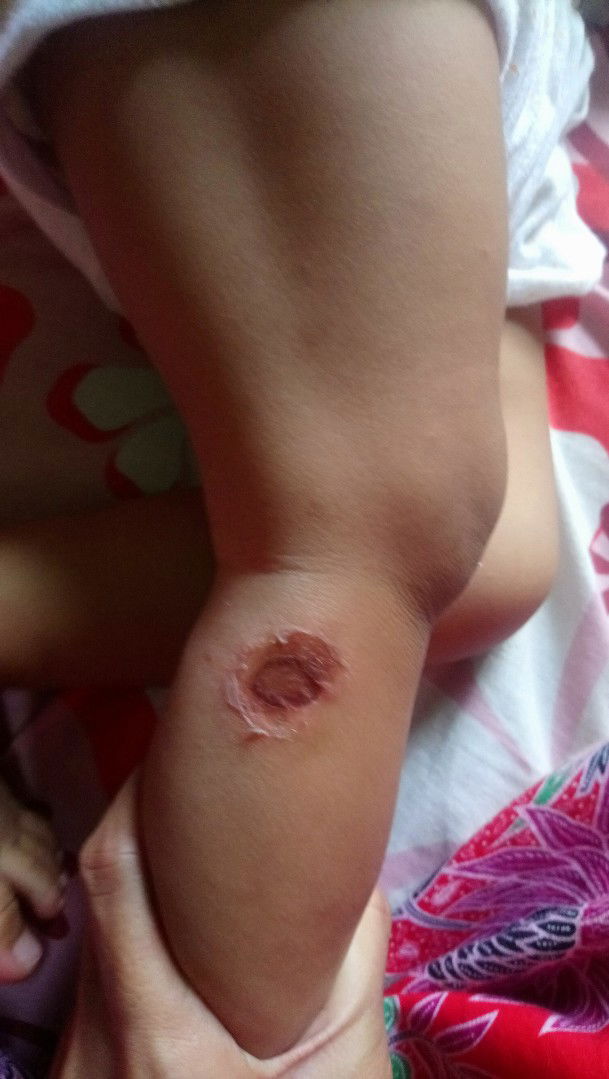 Luka Seperti Kena Api Atau Minyak Panas